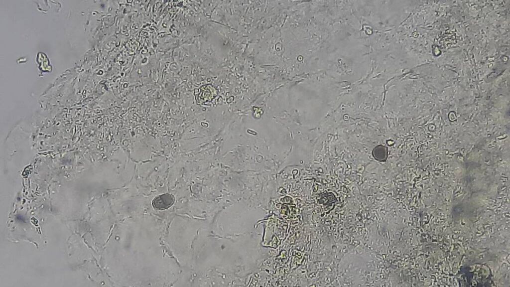 cuerpos escleróticos de cromoblastomicosis visualizados en una preparación microscópica de raspado de piel, 2025